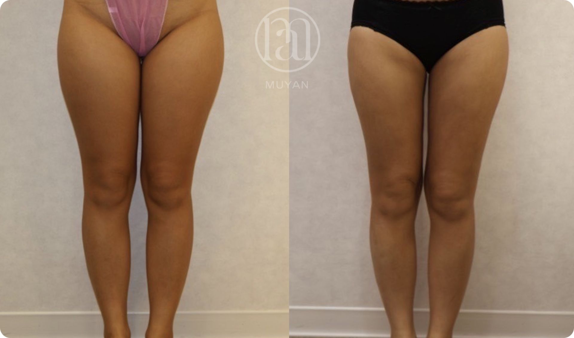 全身體態脂雕管理 分享照片 2