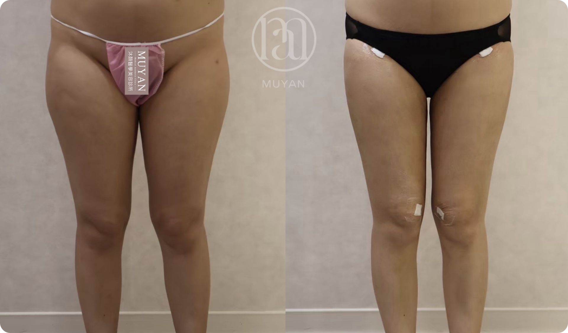 全身體態脂雕管理 分享照片 3