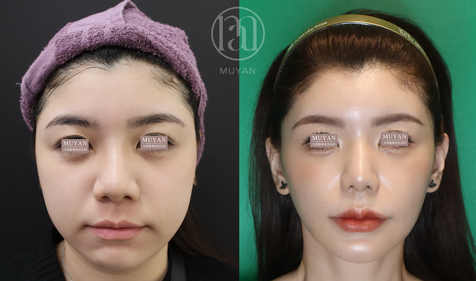 全輪廓整合設計 分享照片 3