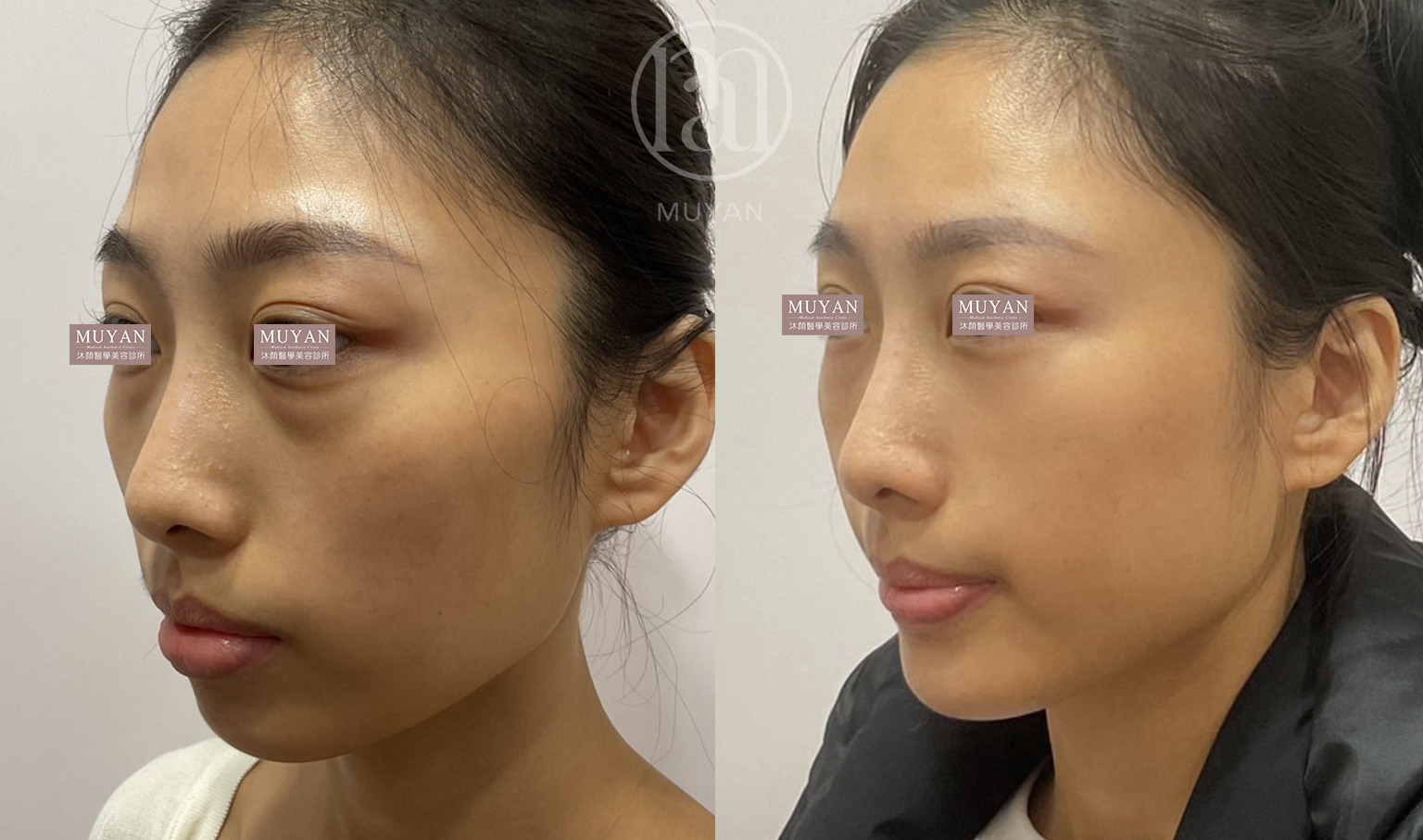 全臉線條加減術 分享照片 2