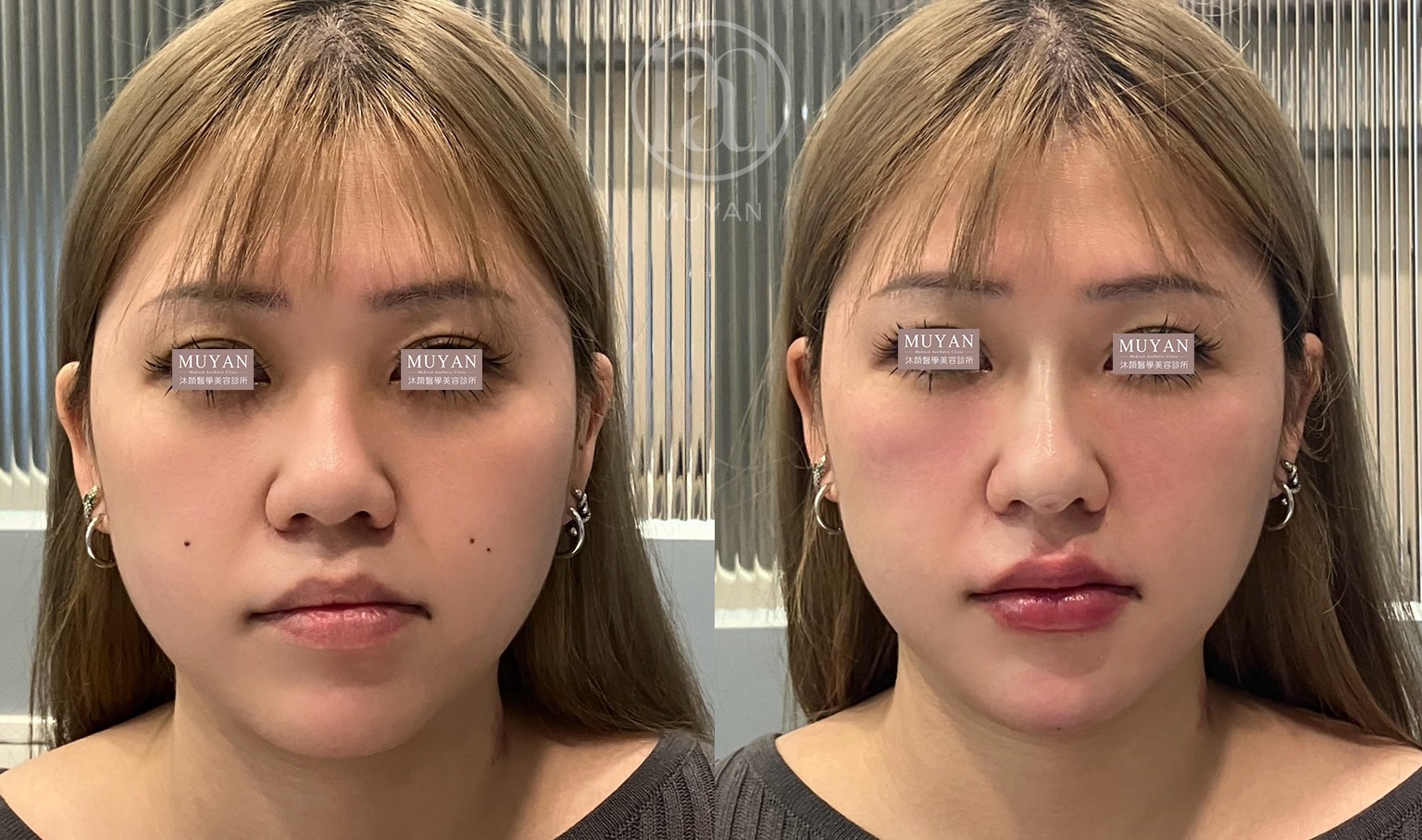 全臉線條加減術 分享照片 3