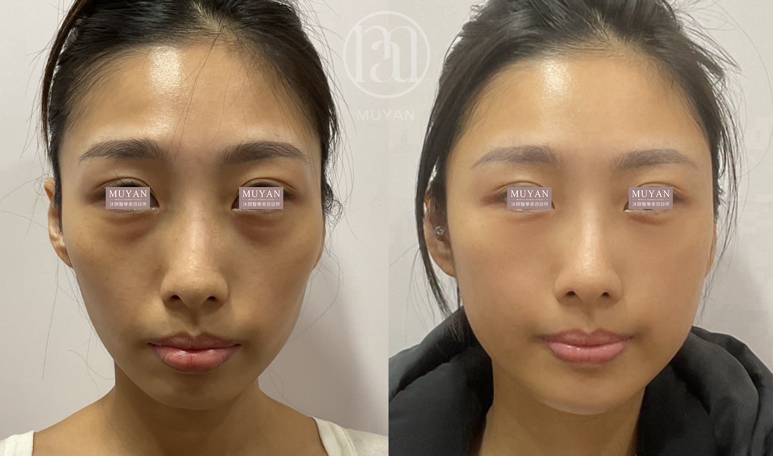 全臉線條加減術 分享照片 4