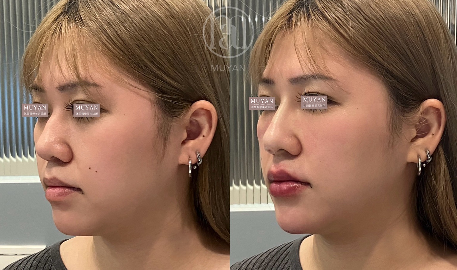 全臉線條加減術 分享照片 5