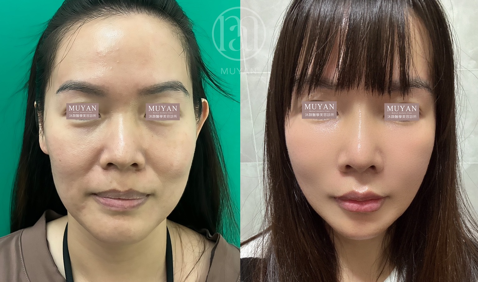 高階輪廓修正術 分享照片 1