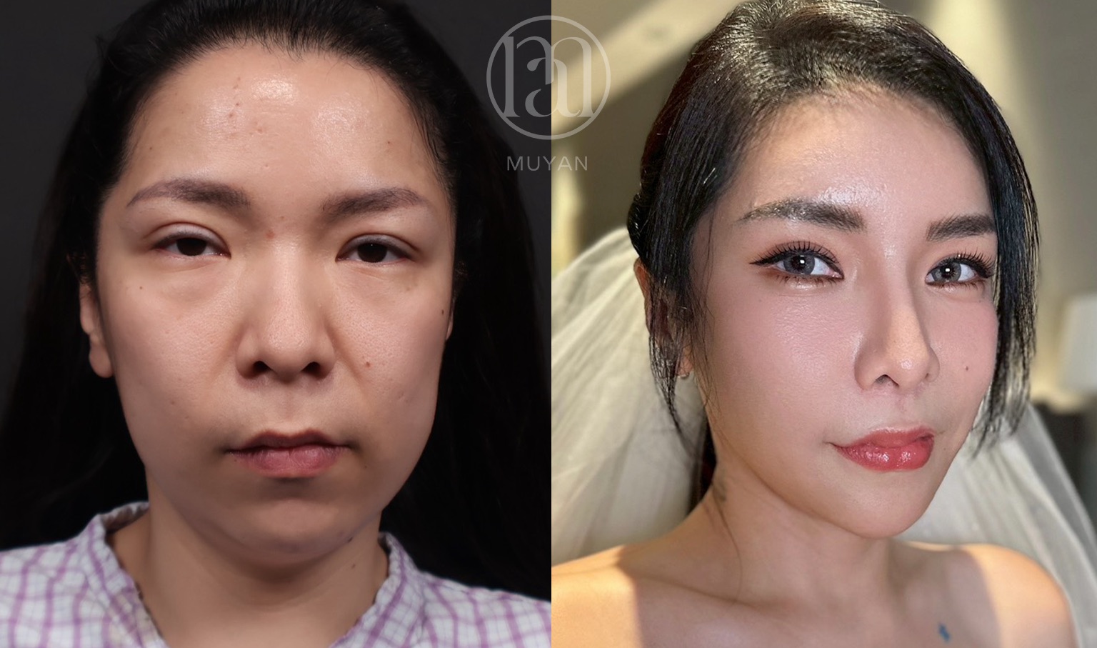 高階輪廓修正術 分享照片 2