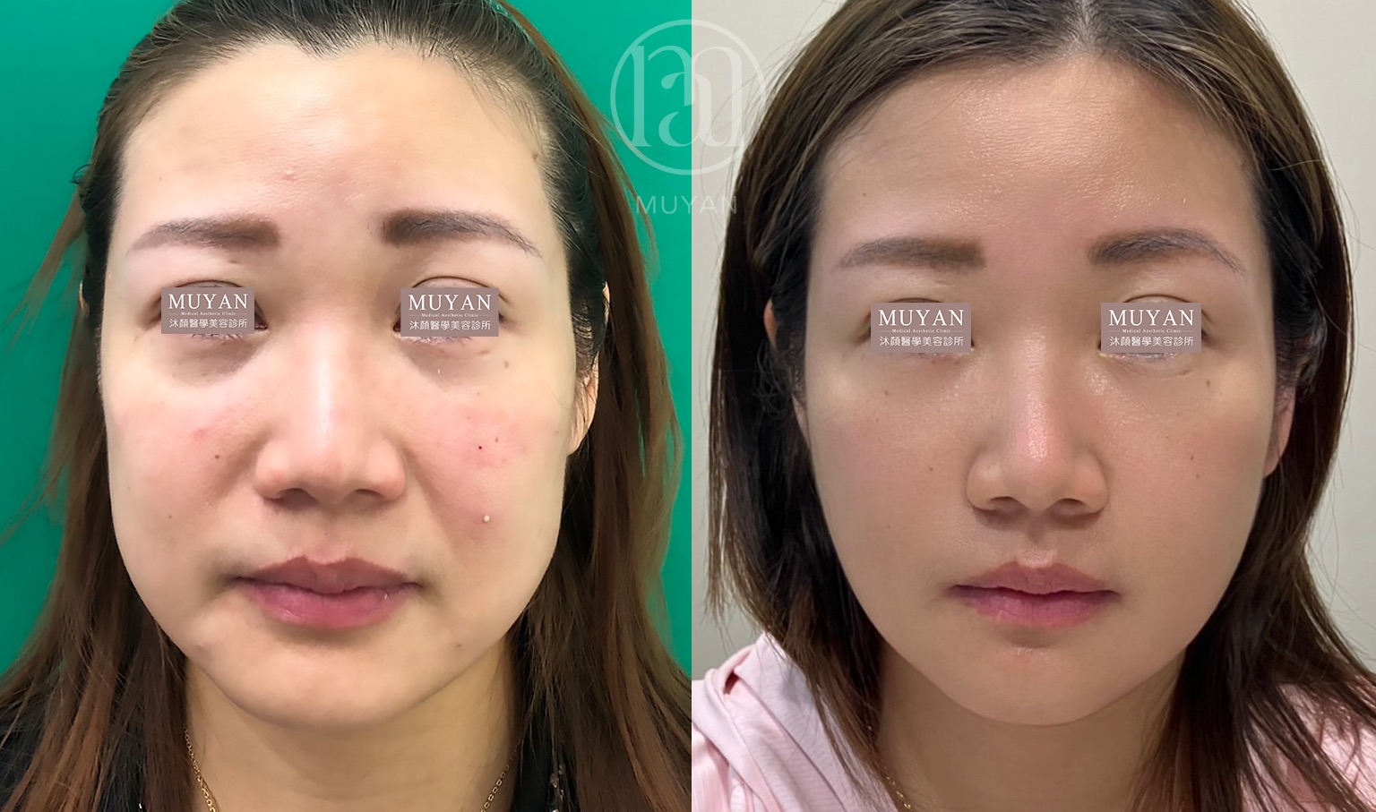 高階輪廓修正術 分享照片 3