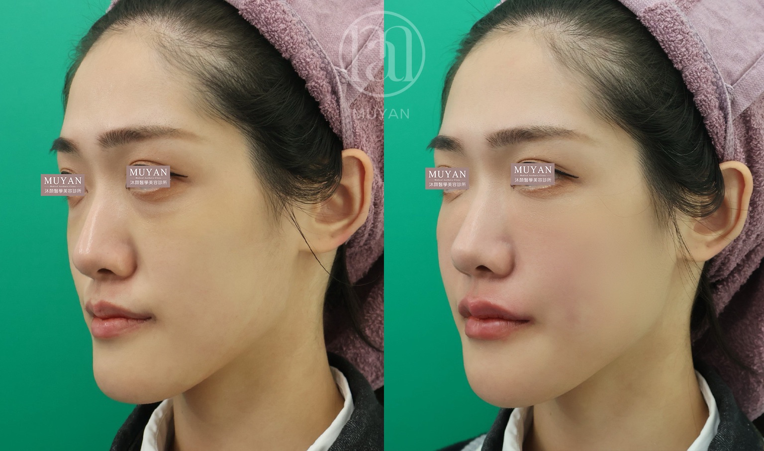 高階輪廓修正術 分享照片 4