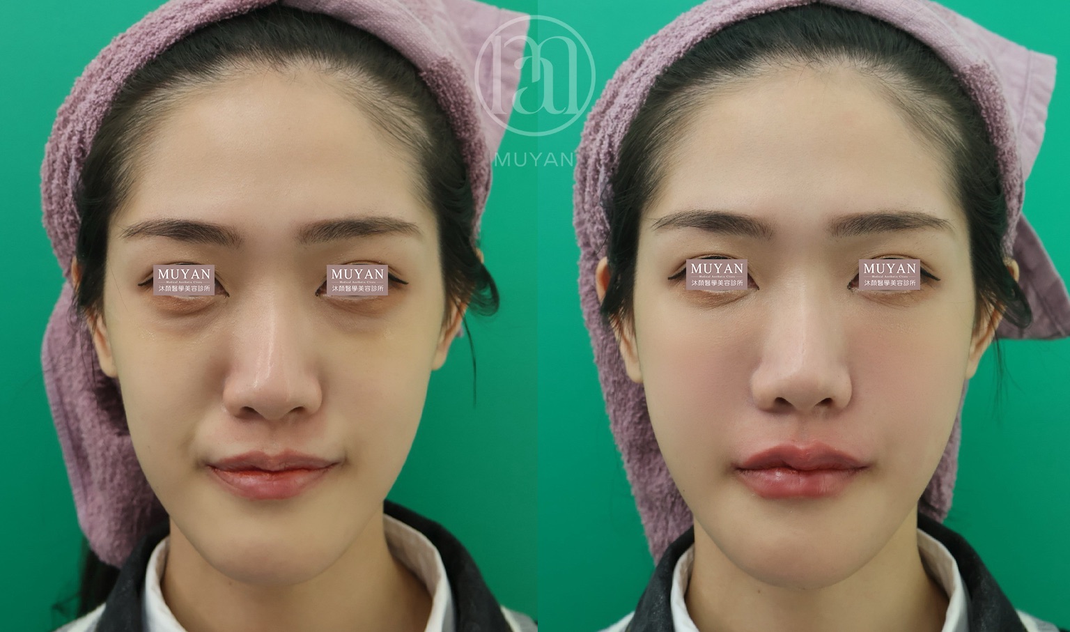 高階輪廓修正術 分享照片 5