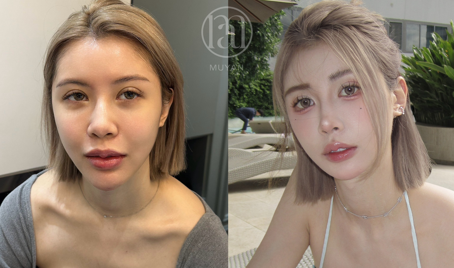 無痕眼袋優化術 分享照片 1