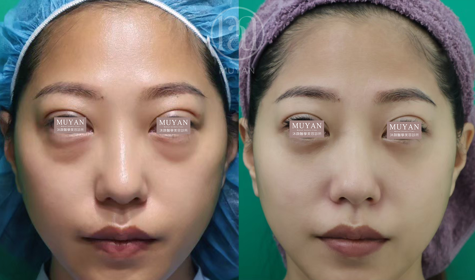 無痕眼袋優化術 分享照片 3