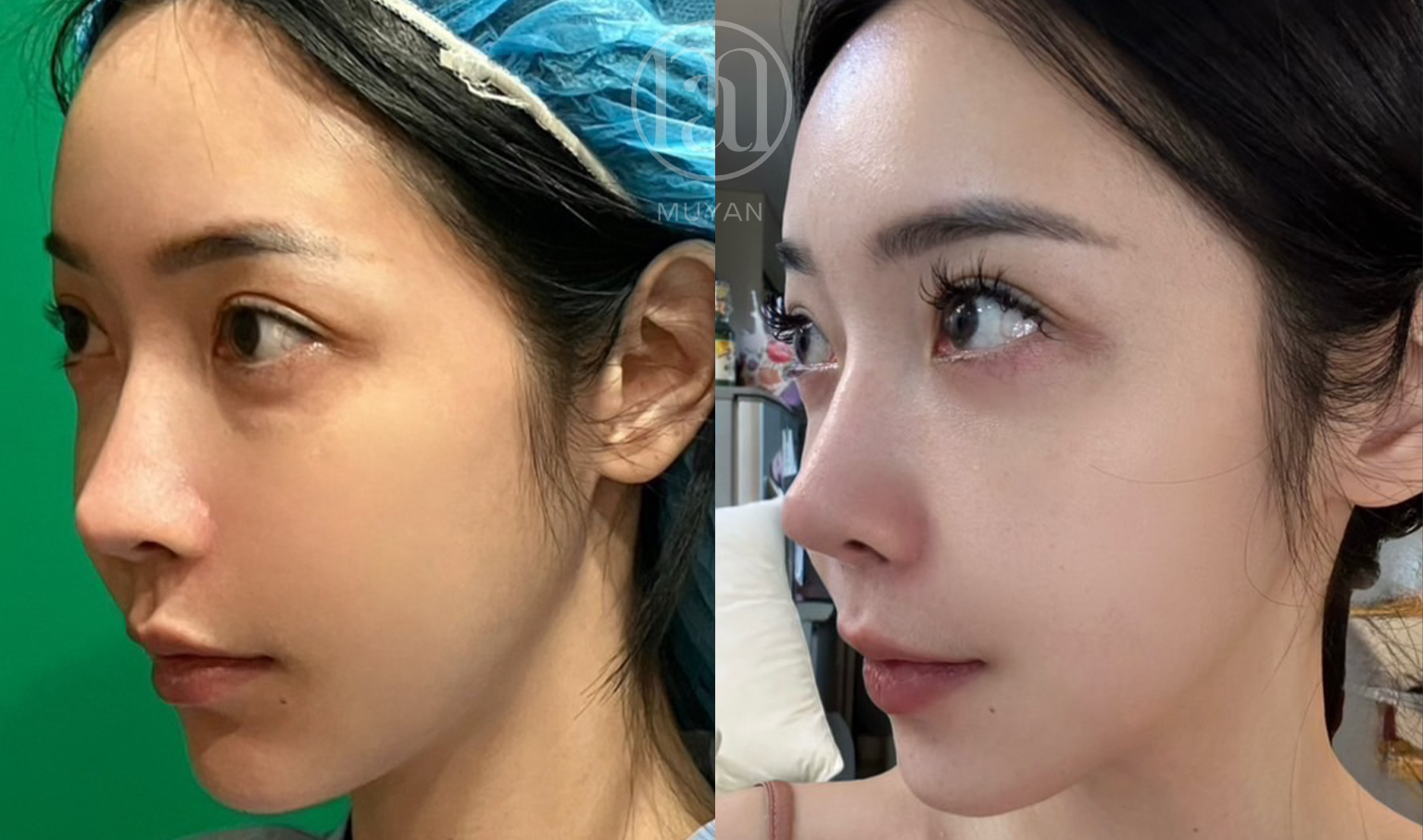 無痕眼袋優化術 分享照片 5