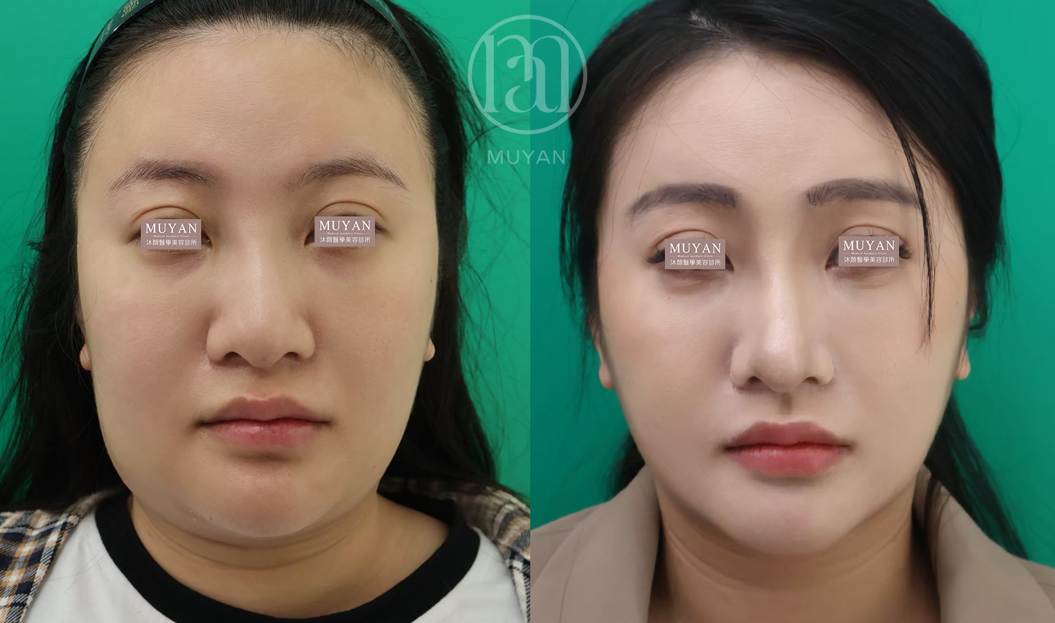 臉頸線條重塑術 分享照片 1