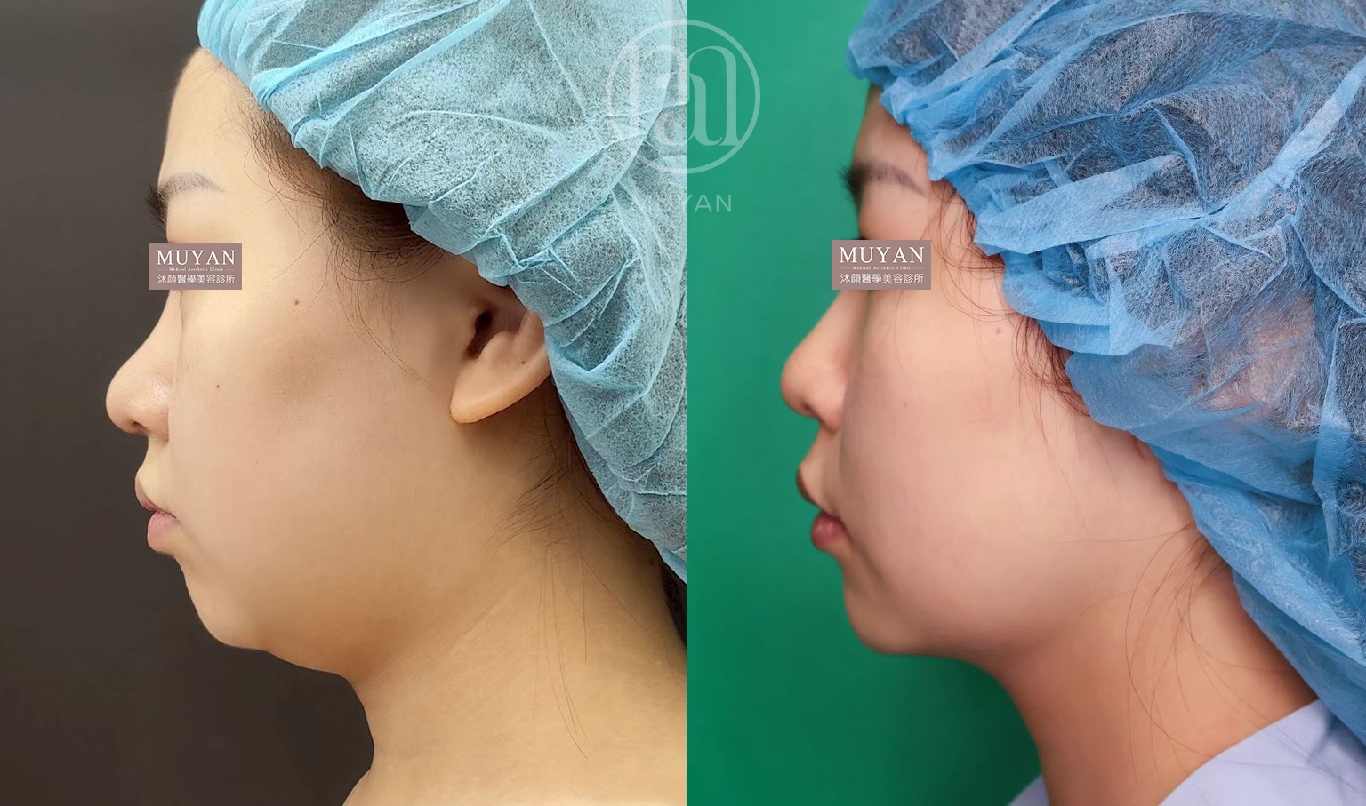臉頸線條重塑術 分享照片 2