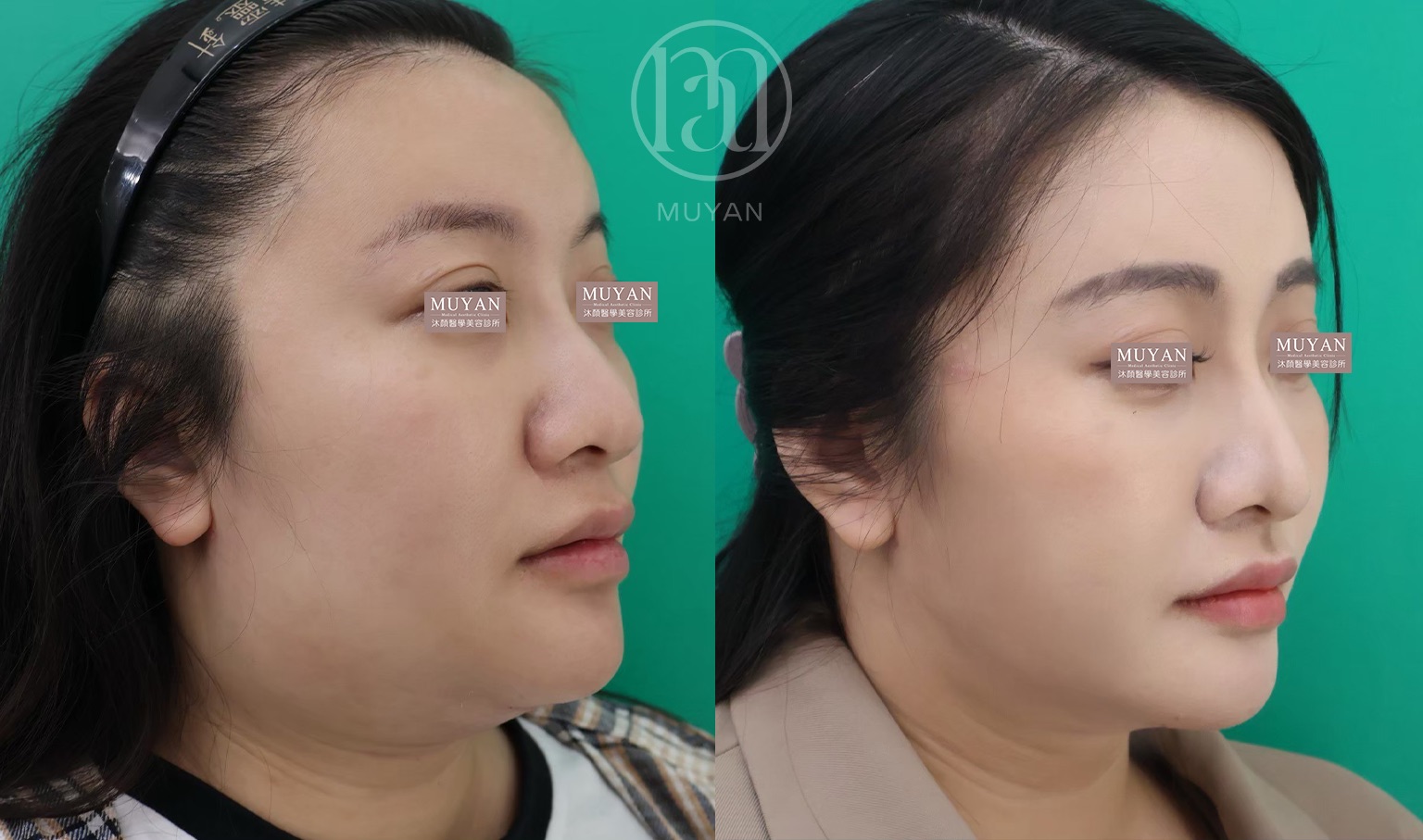 臉頸線條重塑術 分享照片 4