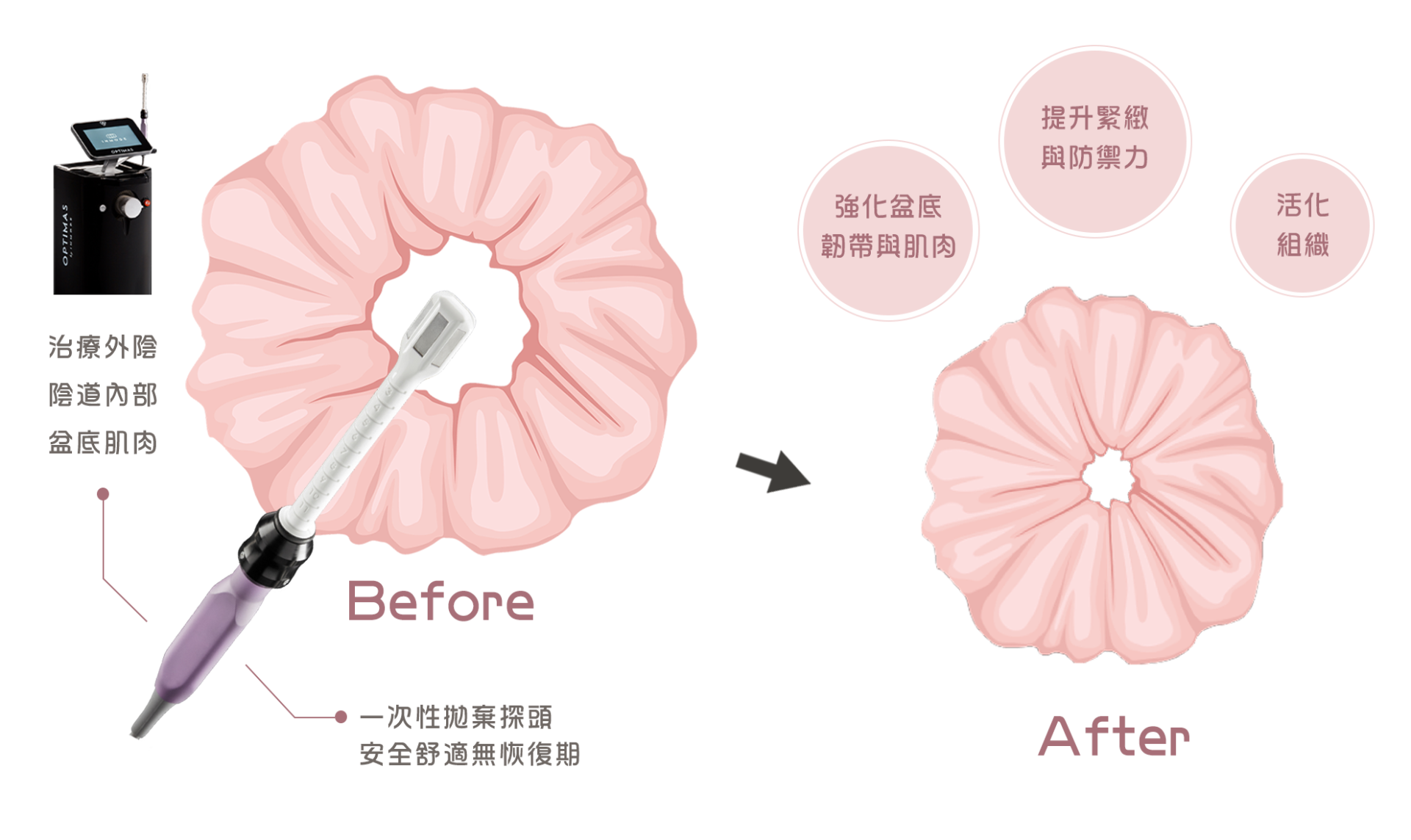蝴蝶電波治療效果