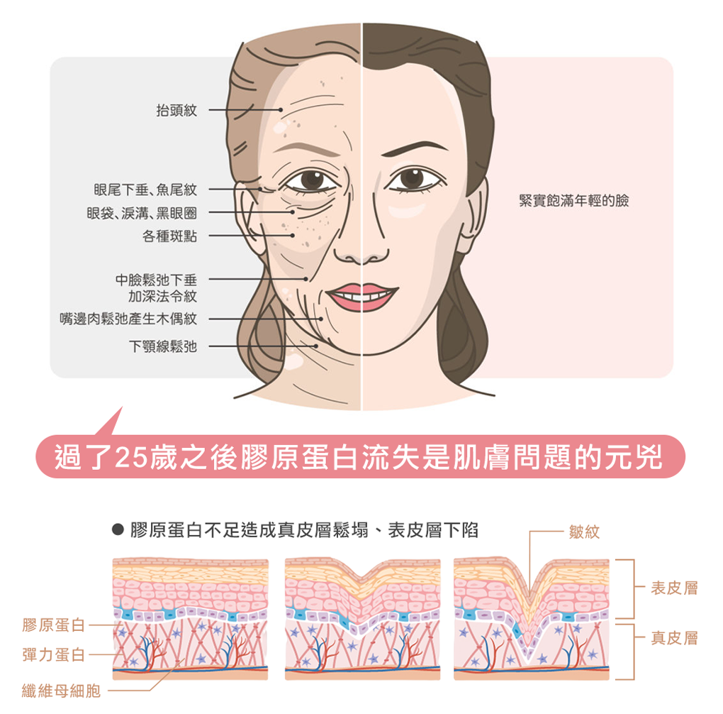 漸進式膠原增生