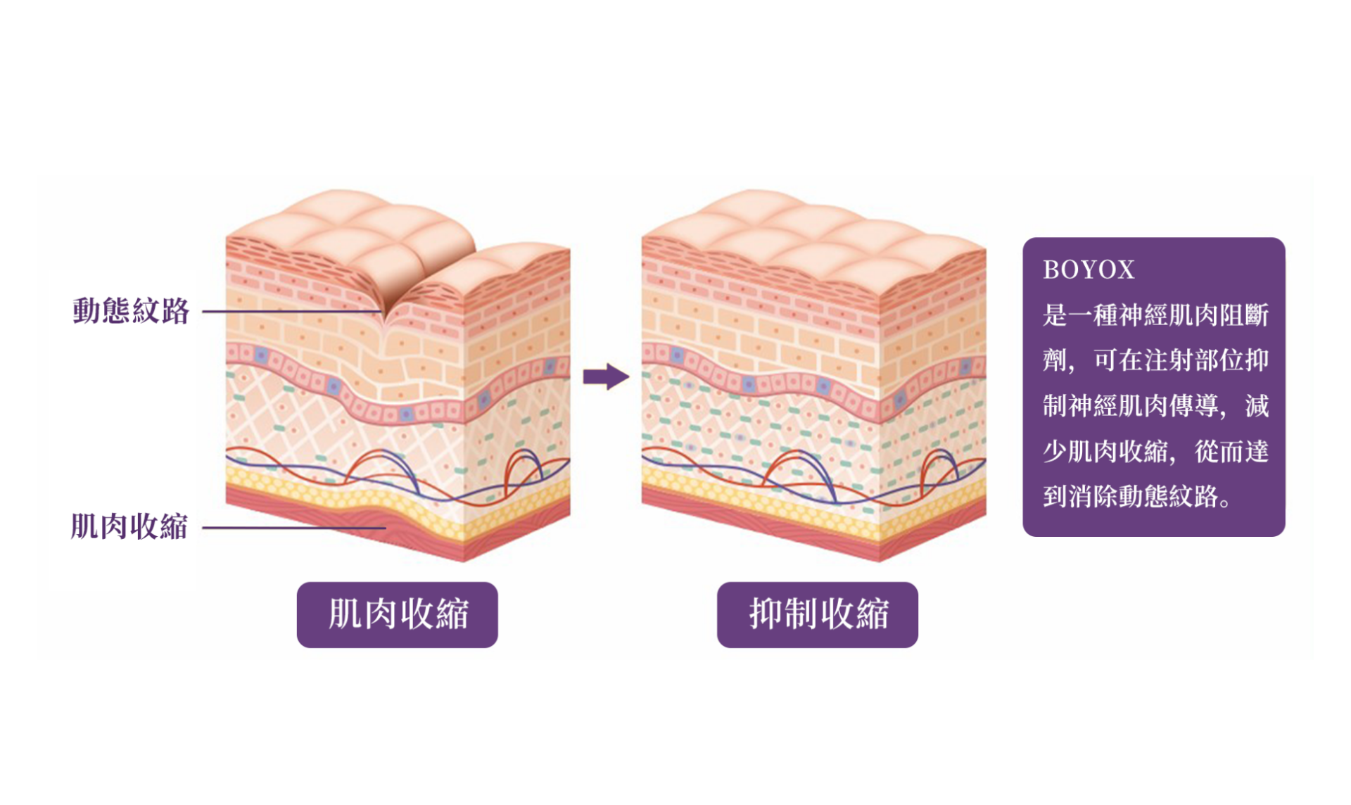 Botox保妥適肉毒｜除皺小臉一舉滿足