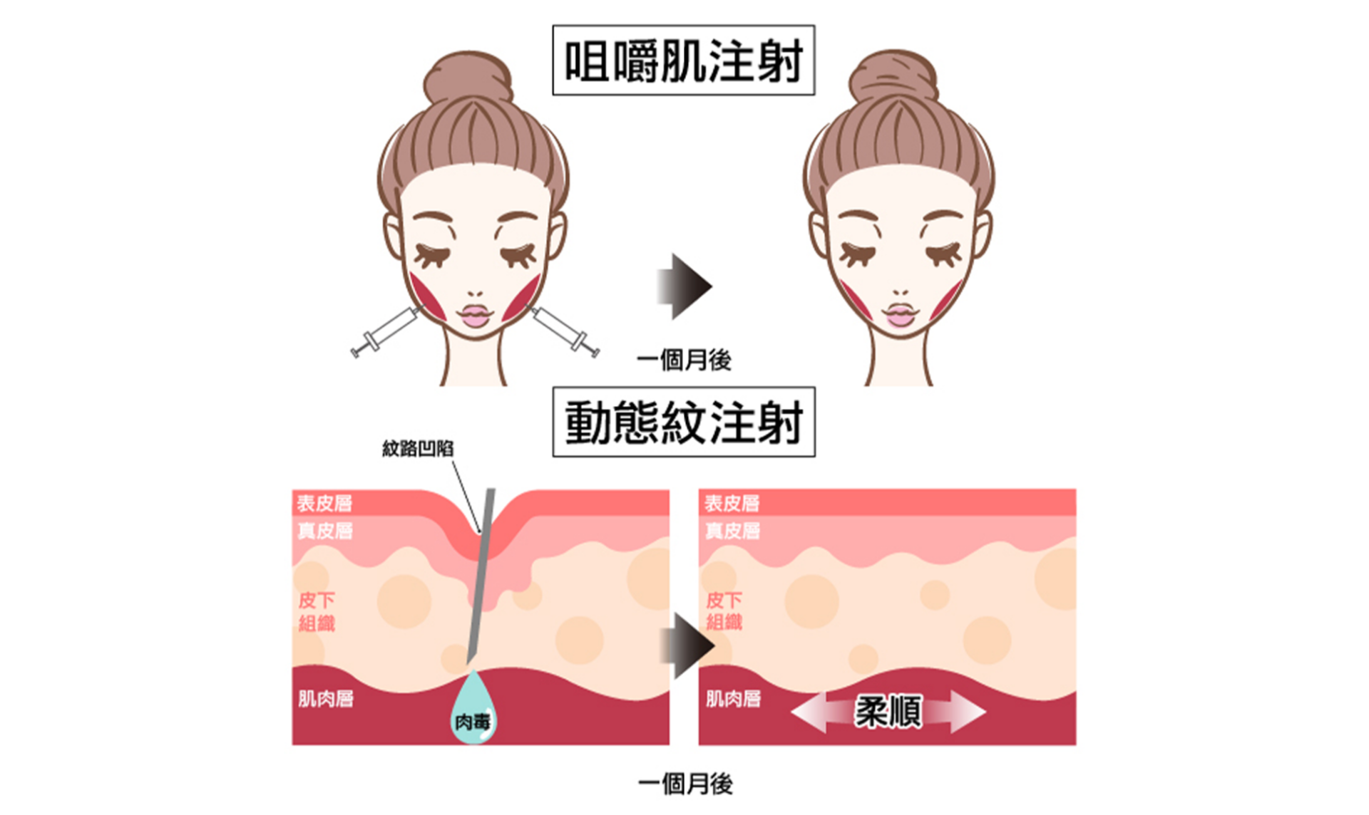 Dysport 儷緻肉毒|精準放鬆表情肌