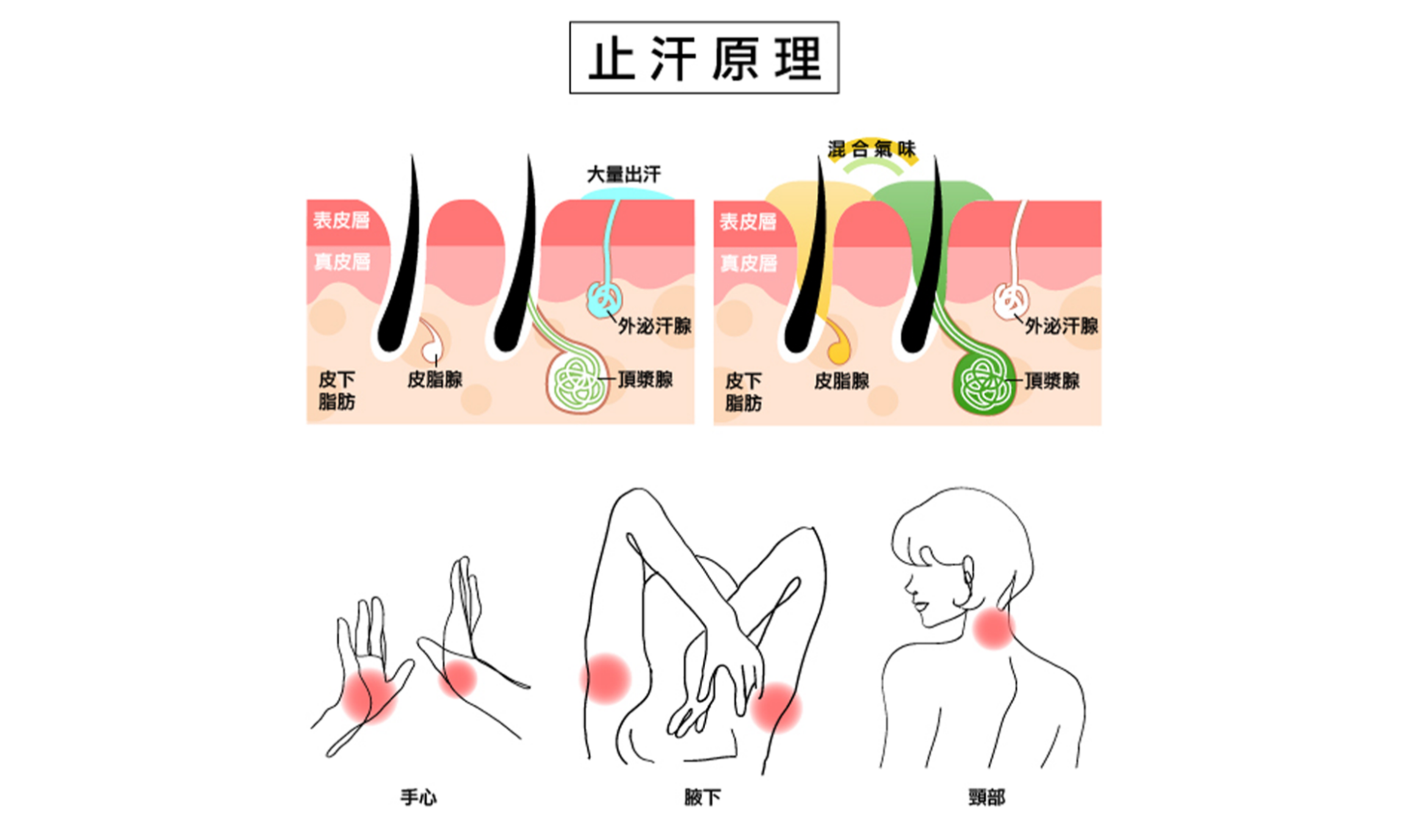 Dysport 儷緻肉毒|廣泛應用於多汗症