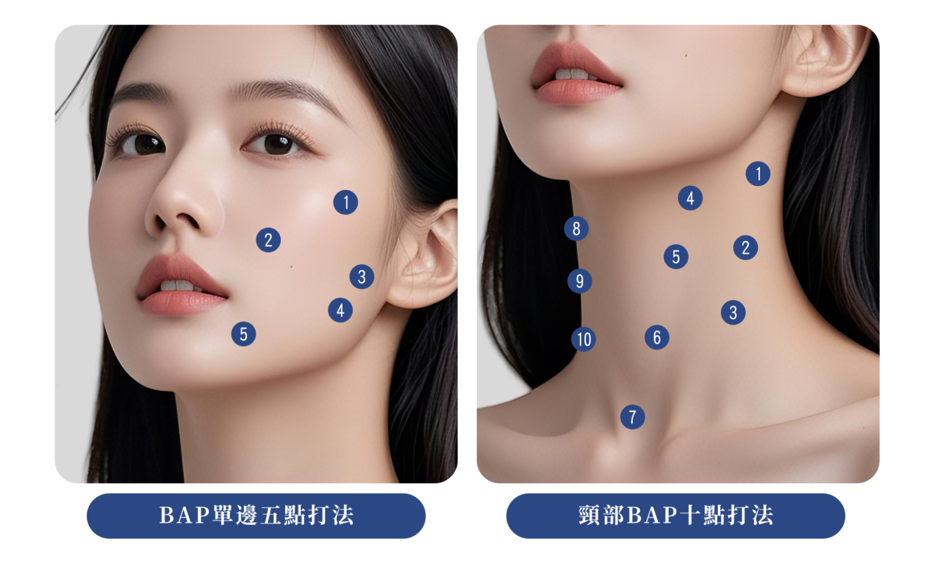Profhilo逆時針|獨特 BAP 五點注射技術