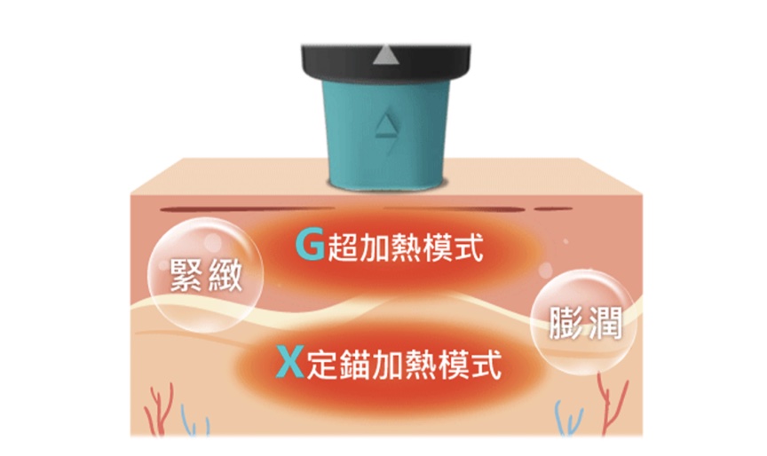 GXG超玩美模式治療示意